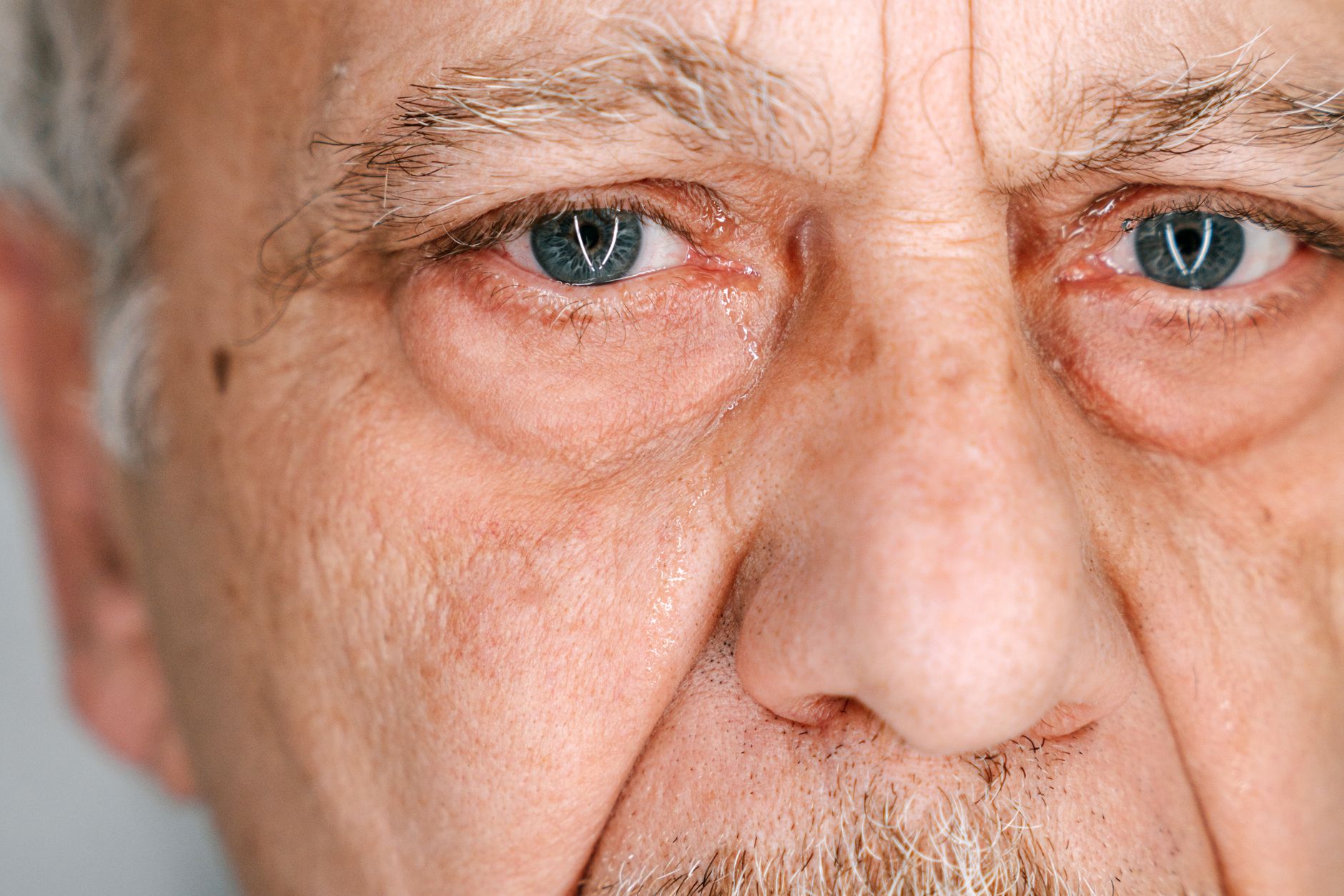 How Common Is Alzheimer's, and Who's Most at Risk?