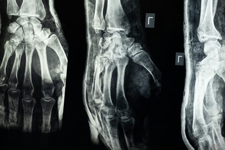 One in Three Hip Fracture Patients Dies Within a Year, CDC Data Shows - Featured image