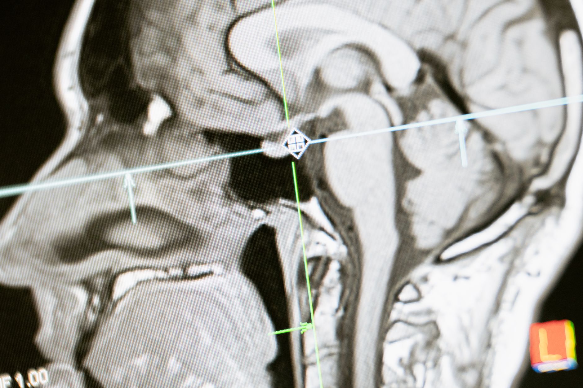 What Makes the Brain Age—And When You Can Reverse It